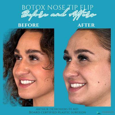 Nose tip lift and nasal bridge slimming with Botox