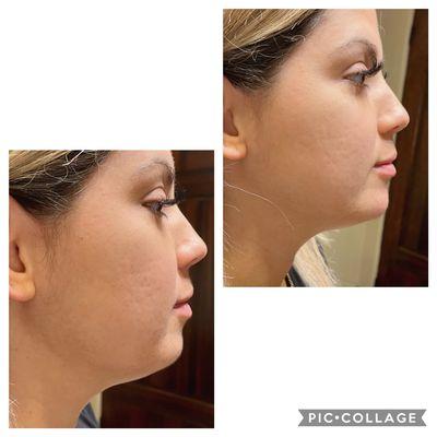 Chin augmentation for double chin!