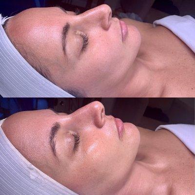 Deluxe HydraFacial before and after just after 1 session