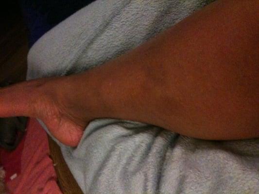 Right calf bruised from foot massage at Zen Day Spa. By the time I left, both legs and my back had black/blue bruises.