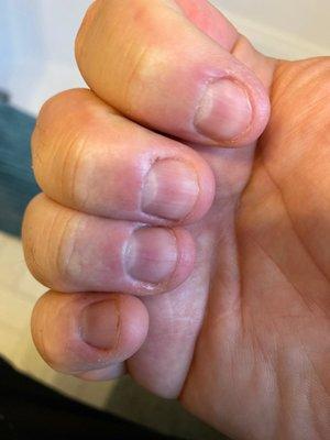 Acute cuticle build up, also not given the option of colored nail polish