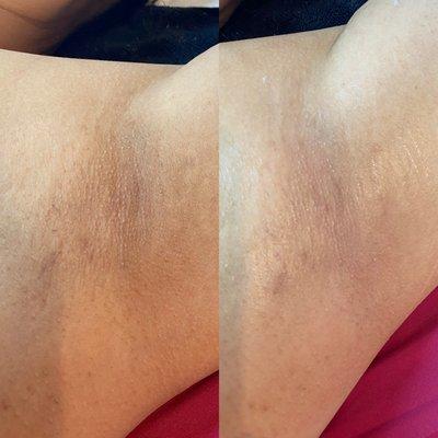 Before & after underarm skin brightening