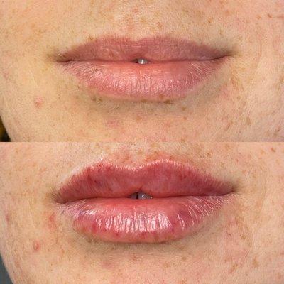 Before after lip filler