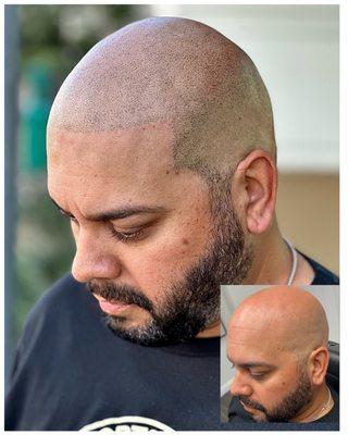 LIFE CHANGING RESULTS WITH SCALP MICROPIGMENTATION. CALL NOW FOR YOUR FREE CONSULTATION 844-4SCALPS