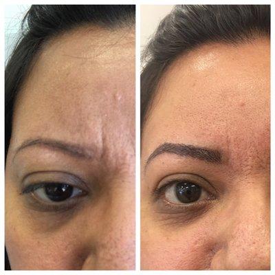 Botched job on left. Eyebrows corrected on left.