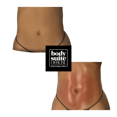 Before & After a combination of our signature Lymphatic Drainage massage, Ultrasound Cavitation & Radio Frequency!