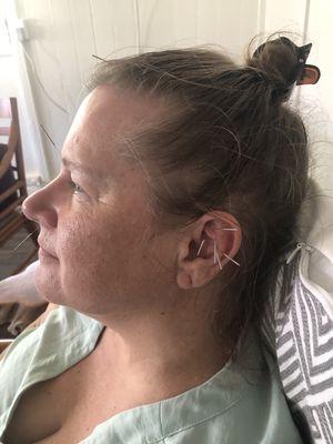 Ear acupuncture at our community clinic.