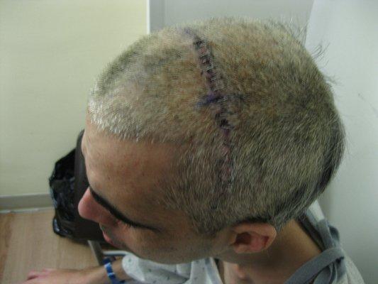 Brain surgery for brain abscess and ITP