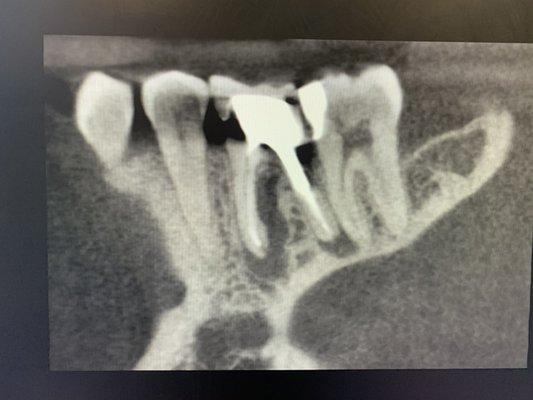 Infected tooth