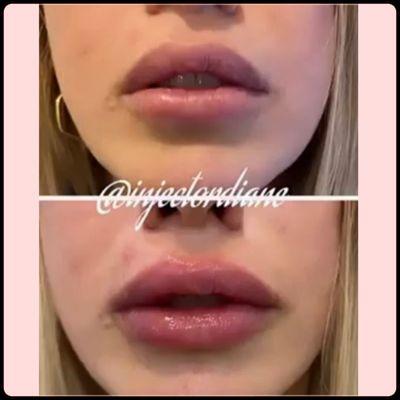 KYSSE LIP FILLER