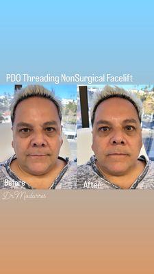 PDO Threading NonSurgical Facelift