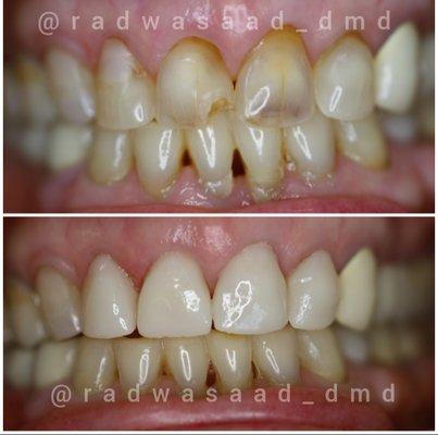 Cosmetic porcelain veneers to fix the broken and misaligned teeth , completed on the same day by Cosmetic Dentist Dr. Radwa Saad