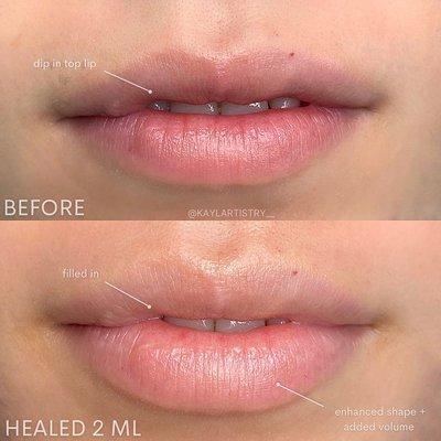 Healed 2 mL Needle-less Filler