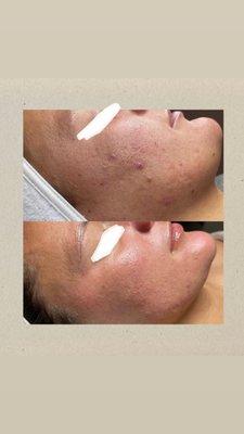 Oxygen RX facial.