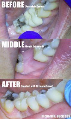 Single Tooth Implant to Replace a Missing tooth with a All White Zirconia Crown