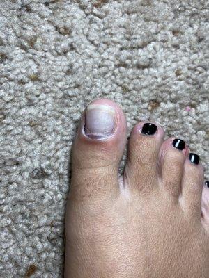 Infected nail