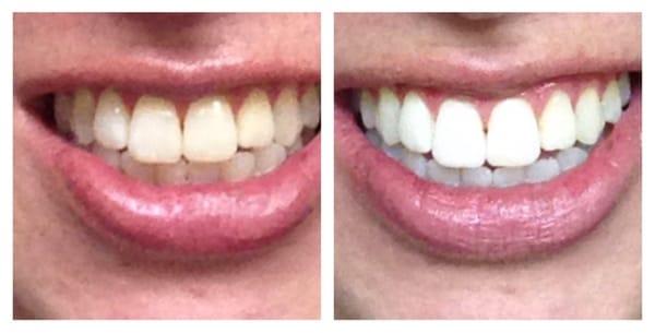 Teeth whitening. Takes about 1.5 hrs. Really happy with my results.