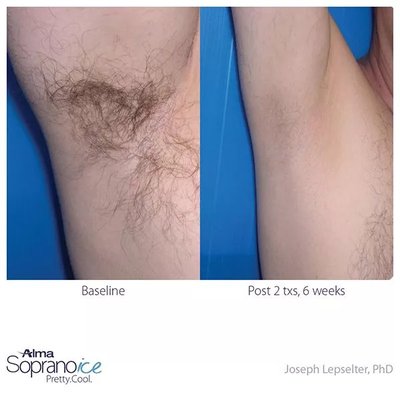 Before and After 6 treatments of Underarm Laser Hair Removal with Soprano ICE