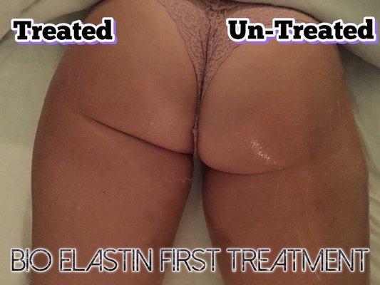 Elastin infusion after one treatment only on left side!