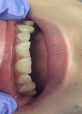 Chipped teeth before repairing