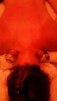 Cupping Therapy