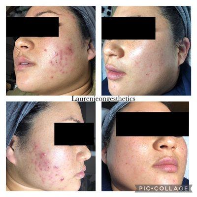 Results from skincare and corrective treatments!