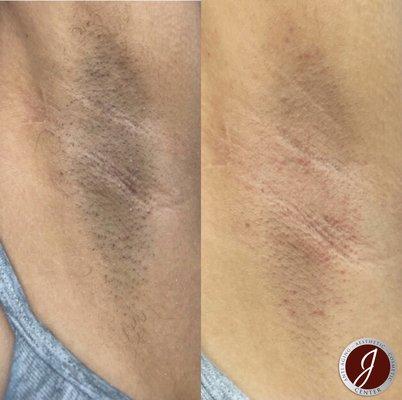 Laser hair removal treatment on underarms