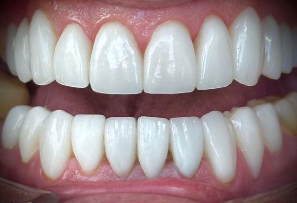 21 Porcelain Restorations (Veneers & Crowns) 1 Life Changing Smile Transformation