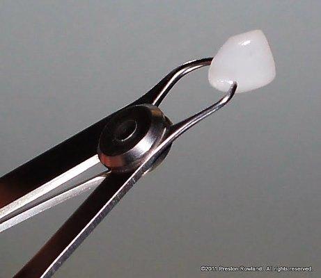 This is the lens thin restorations, that we used on Amine. Lumineer veneers are very minimal preparation of the teeth.