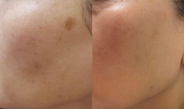 Dark spot remove one treatment