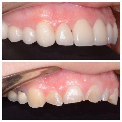 Before and After - This is our actual patient. Photo is shared with patient consent. - Jonathan Miller, DDS.