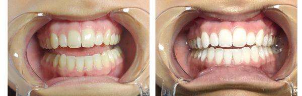 Teeth Whitening results after 1 session.