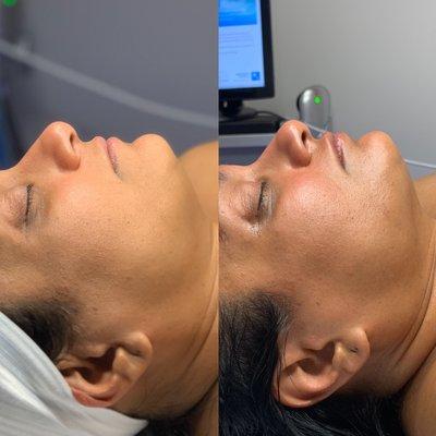 Before and After Microcurrent Facial