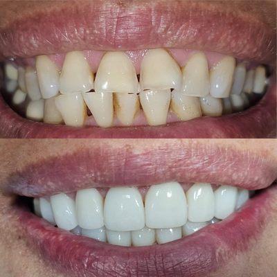 Change your smile with a cosmetic makeover