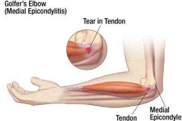 Golfer's Elbow