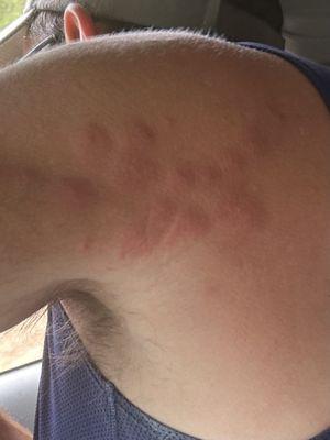 Bed bug bites