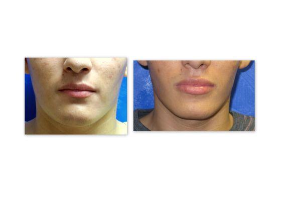 Before and after Juvederm to lips