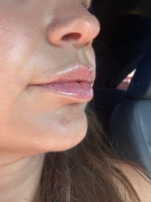 Lip Filler