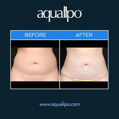 Aqualipo® in Orlando is effective in ridding patients of unwanted fat that won't go away no matter how much you diet and exercise.