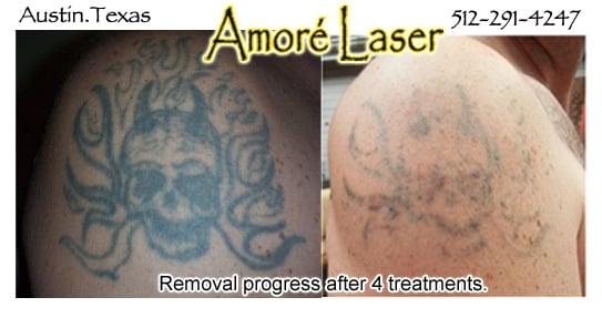 Tattoo Removal is now easier than ever at Amore Laser. We not don't do just Laser Hair Removal anymore. Come see us today!