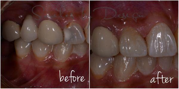 Dental cosmetic treatment