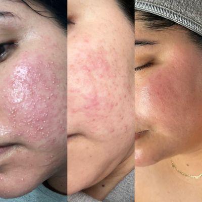 Fungal acne treatment