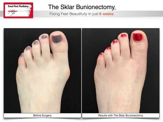 Fixing feet beautifully in just 6 weeks! Visit www.footfirst.com to see more before & after photos in our bunion gallery.