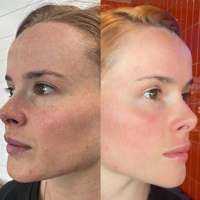 Full face fibroblast before and after