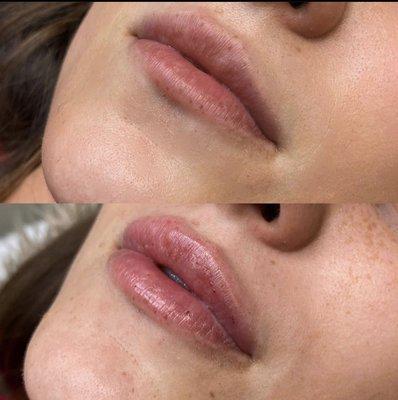 Hylauron Lip Filler