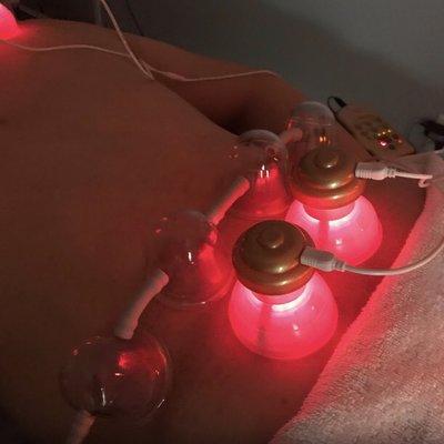 Cupping and E-Stim Therapy