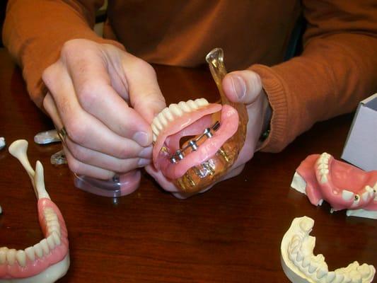 Dentures anchored with implants.