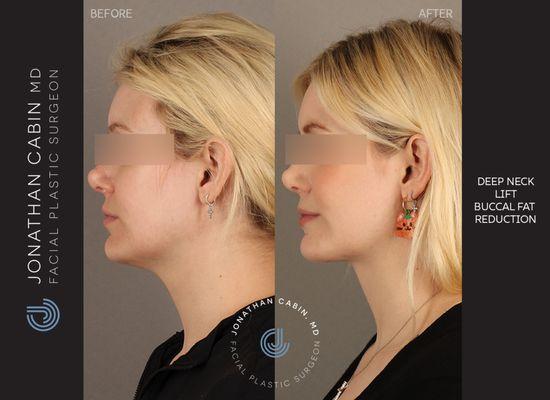 Deep neck lift with deep structural contouring, combined with buccal fat reduction to create a more defined jawline