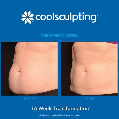 Get 25% OFF CoolSculpting!