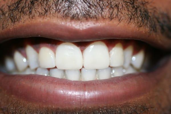 composite veneers